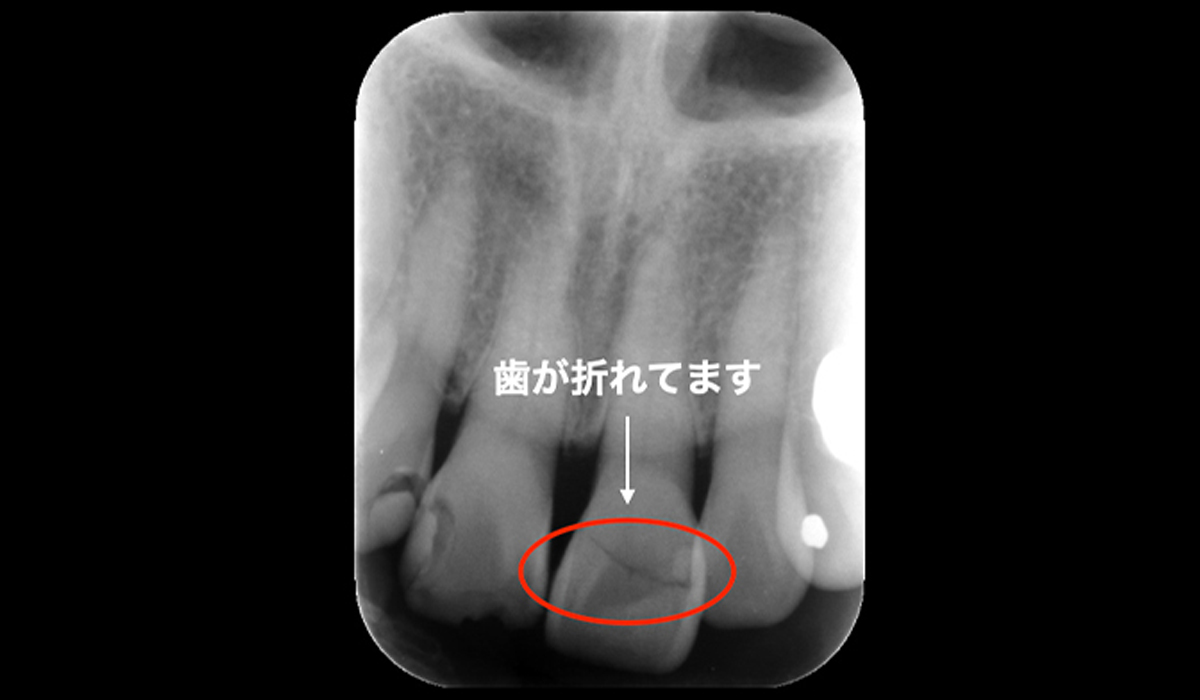 レントゲン写真にて歯が折れていることを確認