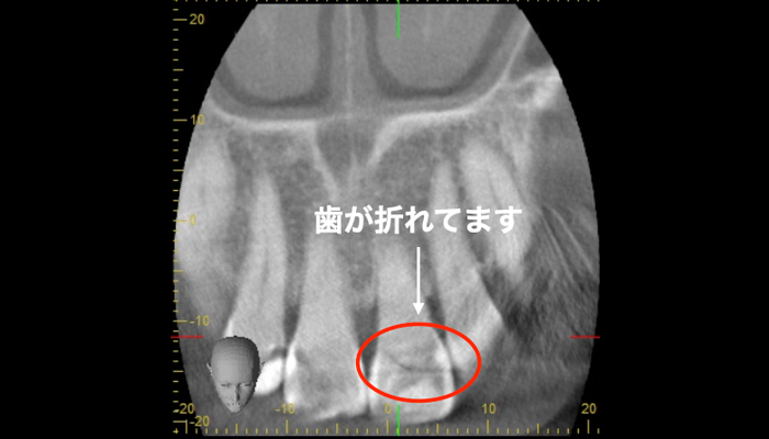 CTを活用した精密検査