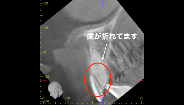 CTを活用した精密検査