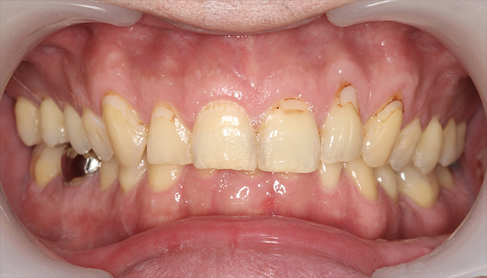 治療後の口腔内