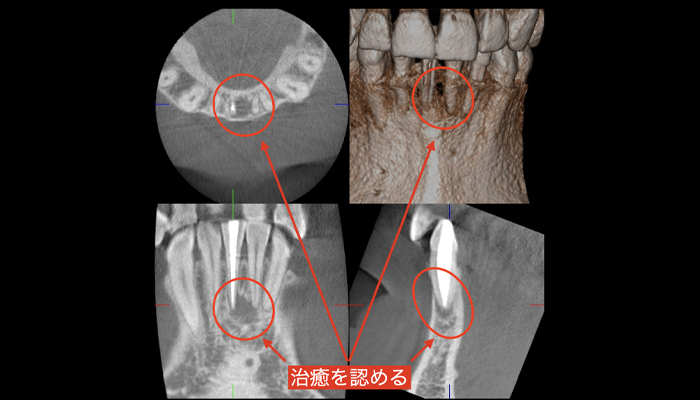 術後