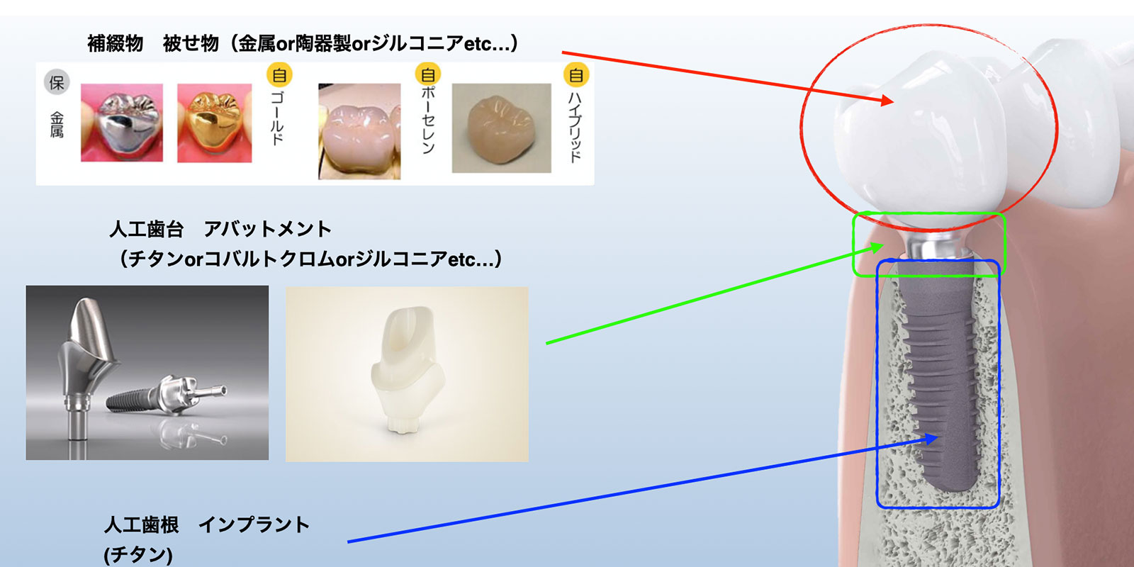 当院のインプラント治療