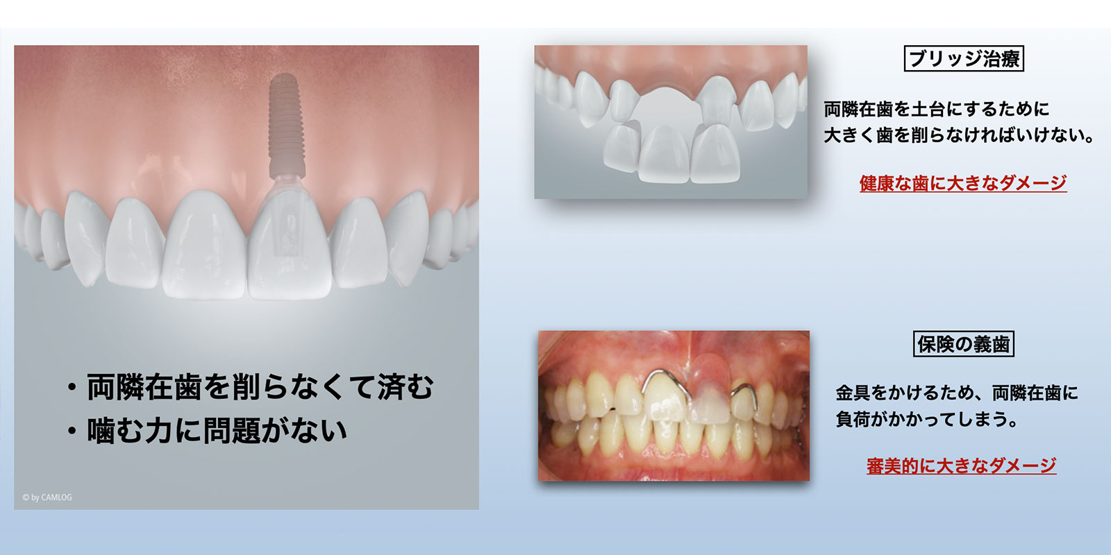 インプラント治療のメリット