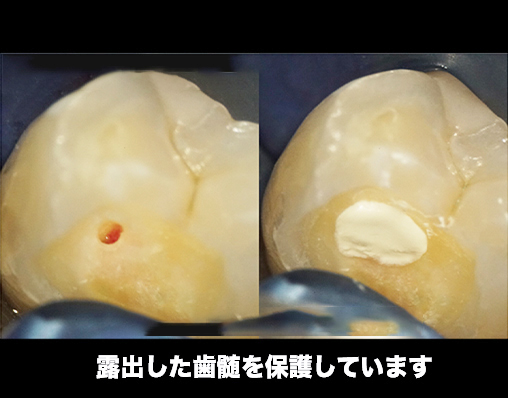 歯科用CT