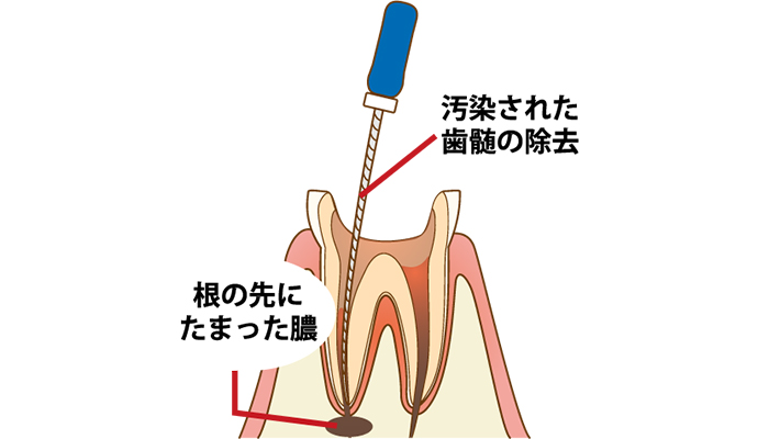 根管治療の流れ