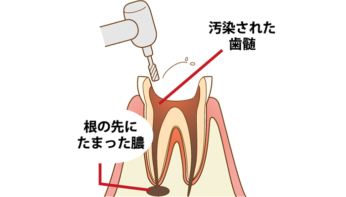 根管治療の流れ