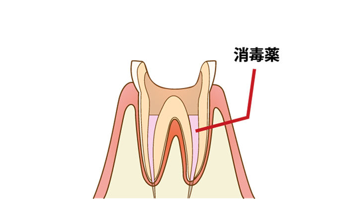 根管治療の流れ