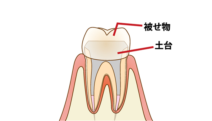 根管治療の流れ