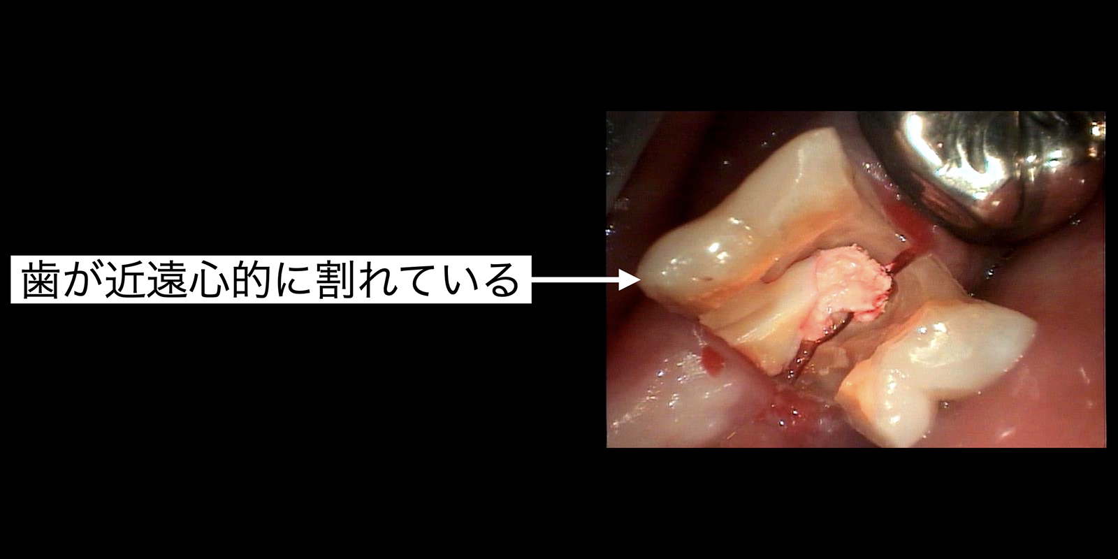 歯が近遠心的に割れている